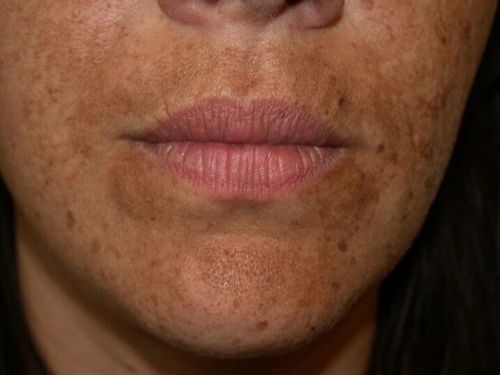 Petele pigmentate de pe față sunt o indicație pentru o procedură cu laser