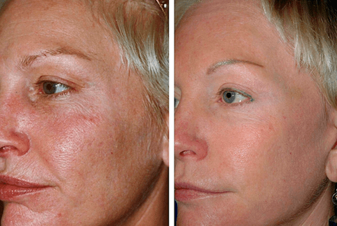 înainte și după întinerirea fracționată a pielii foto 1