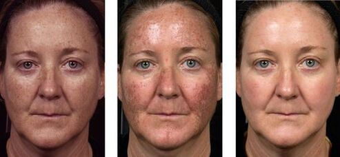 înainte și după întinerirea fracționată a pielii foto 2