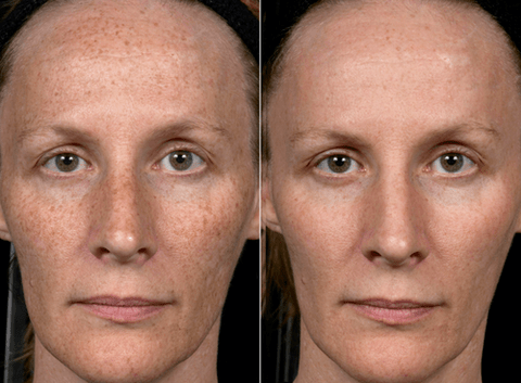 înainte și după întinerirea fracționată a pielii foto 3