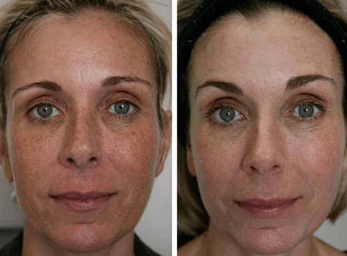 înainte și după întinerirea fracționată a pielii foto 4