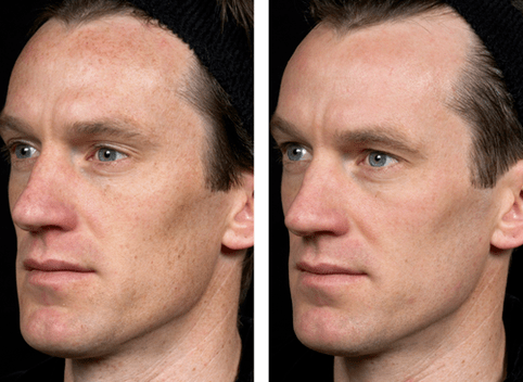 înainte și după întinerirea fracționată a pielii foto 5