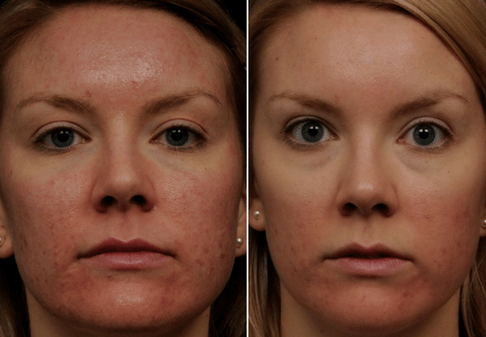 înainte și după întinerirea fracționată a pielii foto 6