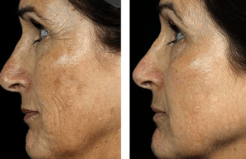 înainte și după întinerirea fracționată a pielii foto 7