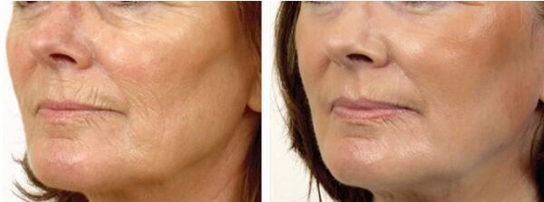 Înainte și după Peeling Laser