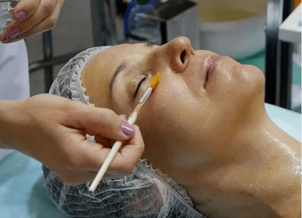 Peeling chimic