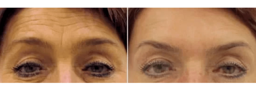 dispozitive pentru întinerire fracționată