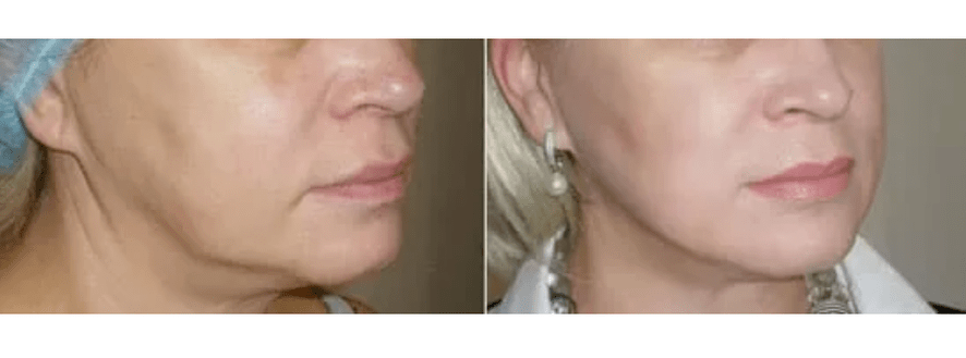 recuperare după întinerirea pielii