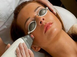 întinerire facială cu laser
